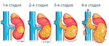 Рак на стомаха е четвърта степен на метастази, както на живо