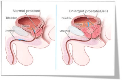 Dimensiunea prostatei este normală la vârste de până la 50 de ani și la bărbații mai în vârstă