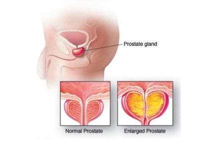 Dimensiunea prostatei este normală la vârste de până la 50 de ani și la bărbații mai în vârstă