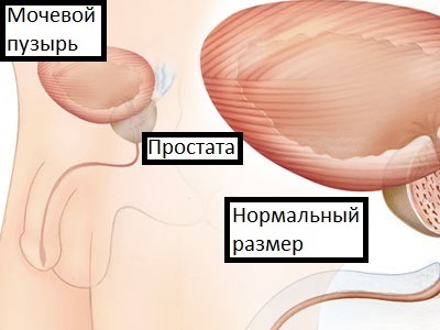 Dimensiunea prostatei este normală la vârste de până la 50 de ani și la bărbații mai în vârstă