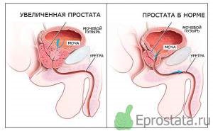 Dimensiunea prostatei este normală