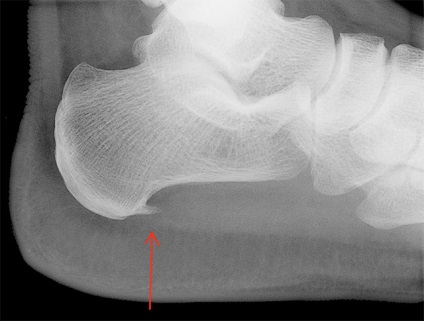 X-ray a piciorului cu toc