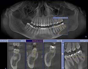 Röntgen fogászat - lásd a láthatatlan - a harapás korrekcióját és a fogsorokat