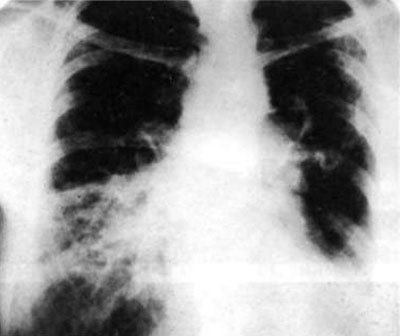 A thoracoscopic tüdőbiopszia eredményei