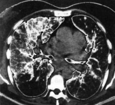 Rezultatele biopsiei toracoscopice pulmonare