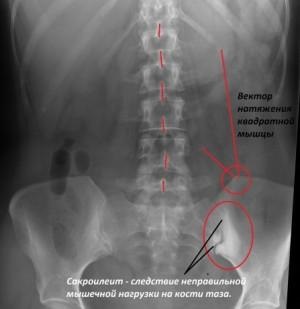 Sacroiliita - cauze de dezvoltare, simptome, tratament și posibile consecințe