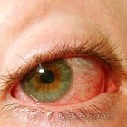 Oftalmia simpatică (inflamația simpatică a ochiului) - de ce apare, simptomele și tratamentul