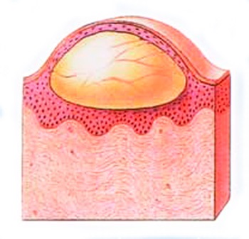 A herpesz tünetei az ajkakon