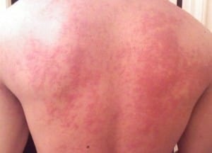 A felnőtt és a gyermek hátán jelentkező bőrkiütések, tünetek és kezelés okoz