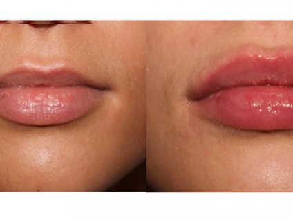 Az ajkak szivattyúzásának módjai a botox ajak szivattyúzásával, elektroporációval és más eljárásokkal