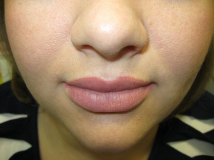 Az ajkak szivattyúzásának módjai a botox ajak szivattyúzásával, elektroporációval és más eljárásokkal
