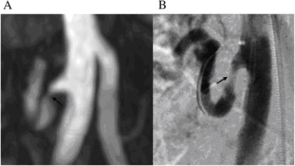 Stenoza arterelor renale ale grefei mai multe artere renale si mr-angiografie
