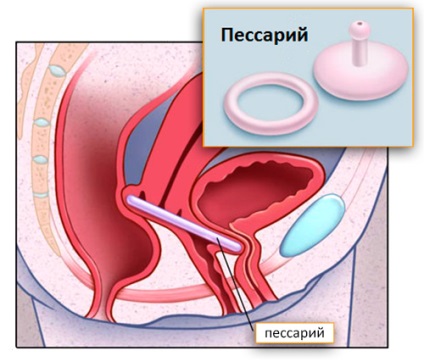 Stresul incontinenței urinare la femei și opțiunile de tratament
