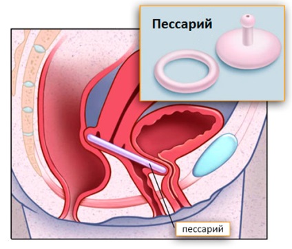 Fokozott vizeletinkontinencia a nőknél és kezelési lehetőségek