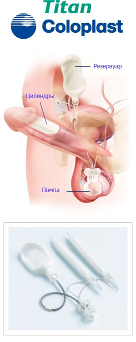 Trei componente proteza a titanului penisului - medical, laborator,