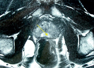 Trusi în diagnosticul de cancer de prostată avansat local - alyayev yu