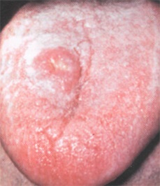 Tuberculoza cavității bucale