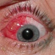 Vasculita la nivelul ochiului, nervului optic și retinei