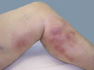 Eczemul venos al extremităților inferioare - cum se tratează