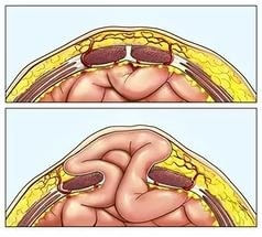 Semnele și tratamentul herniei ventrale