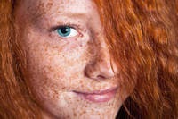 Freckles - miért jelennek meg és hogyan lehet megszabadulni?