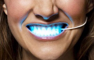 Este albirea dintelui laser dăunătoare?
