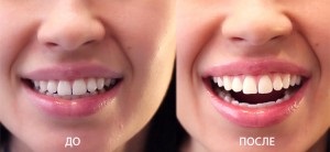 Este albirea dintelui laser dăunătoare?
