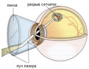 Totul despre lacerocoagularea retinei pe site - mgk