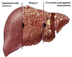 Doriți să aflați ce oportunități se deschide drogului sophosbuvir și cum va fi hepatita c, citiți