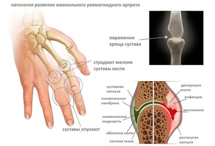 Artrita reumatoidă juvenilă - cauze, simptome, tratament