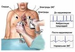 Înlocuirea supapei cardiace