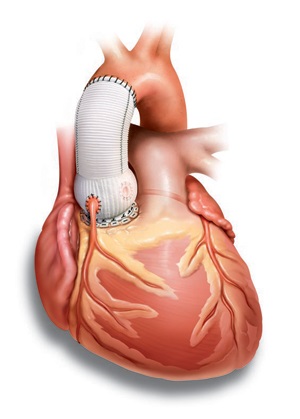 Înlocuirea valvei cardiace - cardiologie în Israel