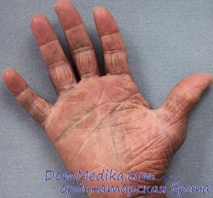 Protecția pielii cu dermatită a mâinilor