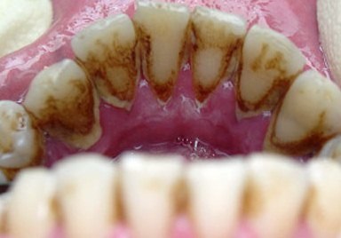 Pasta de dinti pentru indepartarea tartrului pentru a alege care ajuta, recenzii, tratament dentar