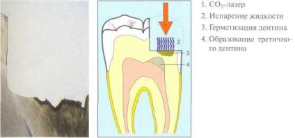 07 Laser în endodonție
