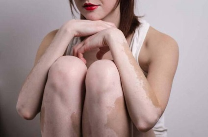 5 Otthoni jogorvoslatok, amelyek segítik a vitiligót