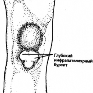 7 Specii de bursită a articulației genunchiului și metodele de tratament ale acestora