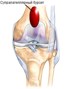 7 Specii de bursită a articulației genunchiului și metodele de tratament ale acestora