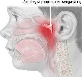 Simptomele și prevenirea adenoidelor