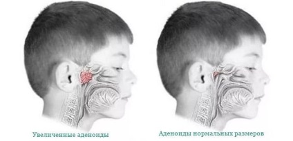 Adenoizii la copii simptome și tratament - dezvoltarea copilului