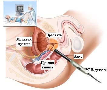 Definiția adenomului de prostată, semne și simptome, opțiuni de tratament - medglobus medglobus