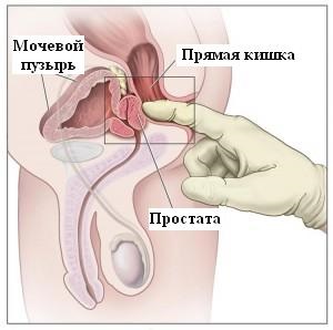 Definiția adenomului de prostată, semne și simptome, opțiuni de tratament - medglobus medglobus