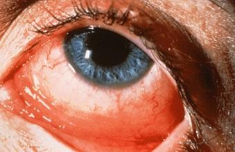 Conjunctivită alergică - conjunctivită - boli oculare - lista bolilor