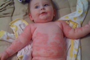 Alergie la simptomele de drojdie la copii