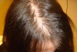 Alopecia (chelie) la femei, cauze, tratament