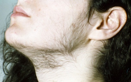 Androgén hajhullás okoz és kezelés a nőkben és a férfiakban, blog a haj
