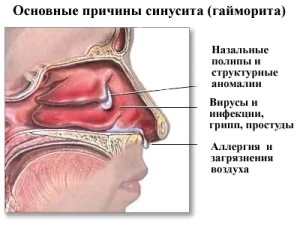 Антибіотики при нежиті у дорослих як вибрати