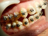 Aparat herbsta - tratament ortodontic al ocluziei distal - antonin b
