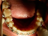 Eszközök herbsta - ortodontikus kezelés a distalis elzáródás ellen - antonin b