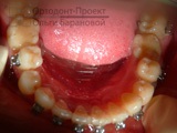 Aparat herbsta - tratament ortodontic al ocluziei distal - antonin b